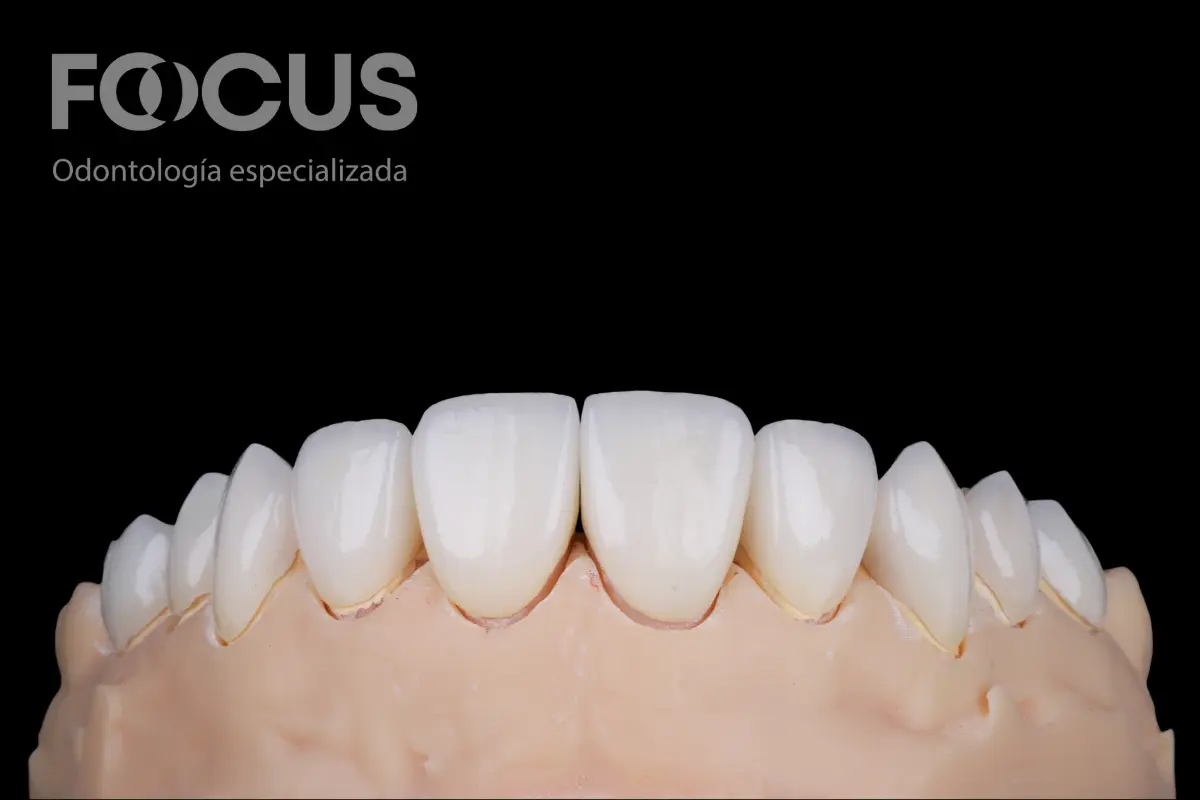 Carillas de Porcelana y Cerámica