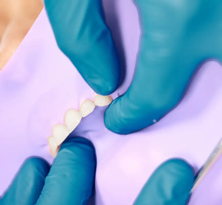 Ilustración de un puente dental de tres piezas reemplazando un diente ausente