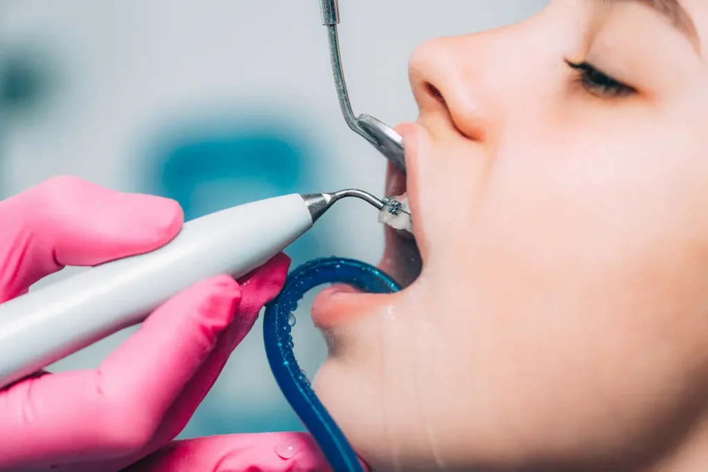 Limpieza dental con punta de ultrasonido para retirar el sarro de los dientes inferiores