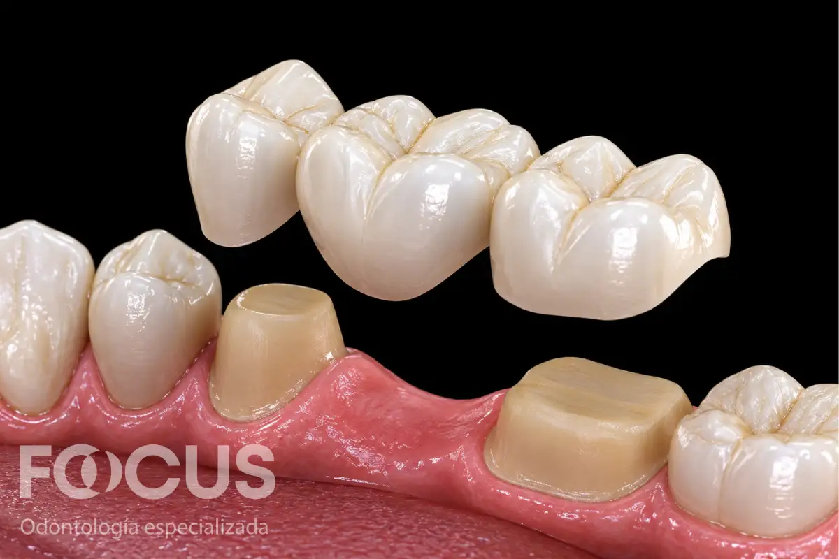 Modelo-anatomico-de-un-puente-dental-fijo-metal-porcelana-sobre-dos-dientes-pilares