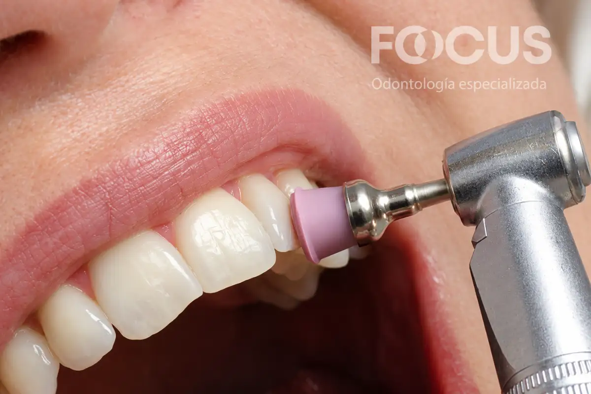 Odontólogo realizando una profilaxis dental a una paciente adulta en un consultorio de Quito