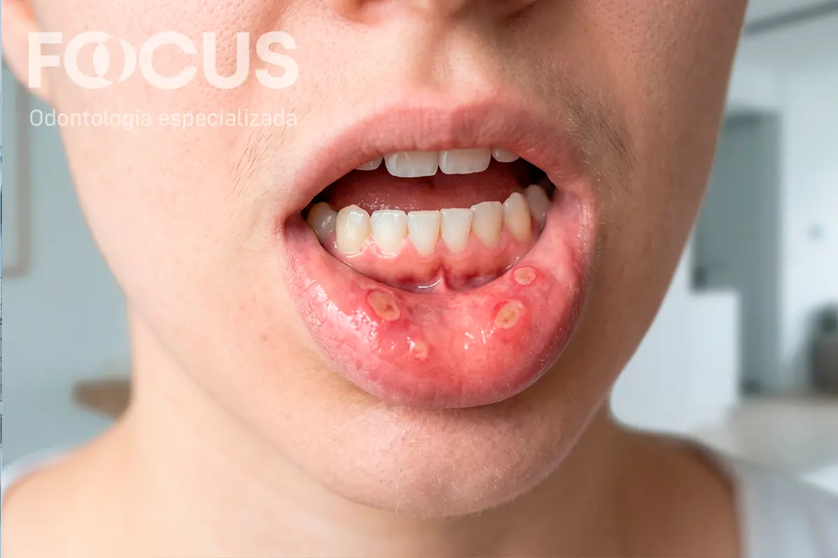 Primer plano ilustrativo de llagas en la boca en la cara interna del labio inferior