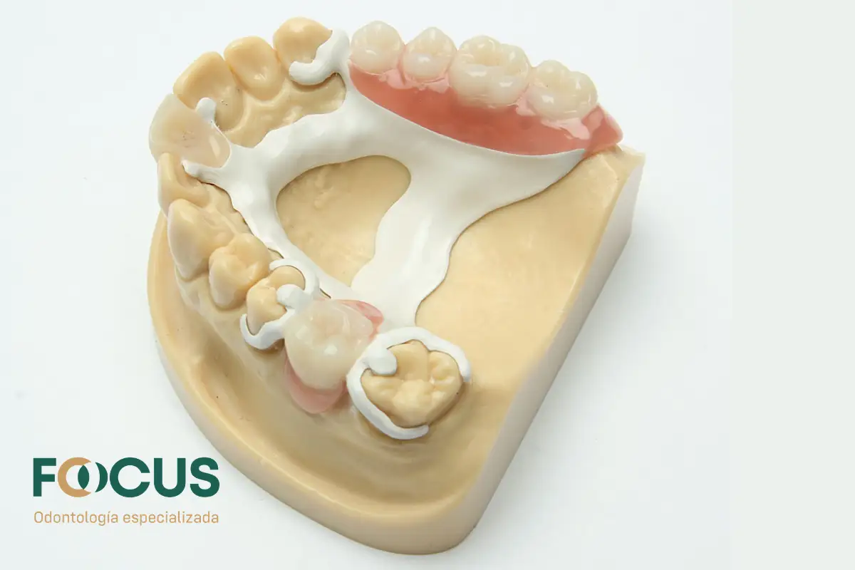 Prótesis parcial removible esquelética con dientes de resina