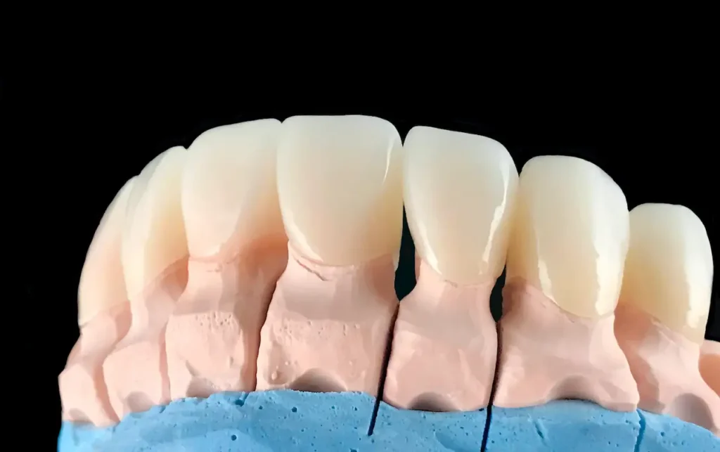 Puente dental Maryland con aletas adheridas a la cara interna de los incisivos